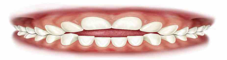 Deglutizione atipica